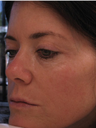 Close-up of a woman’s face showing skin texture and tone, illustrating the effects of Triniti™ treatment for improved skin appearance.