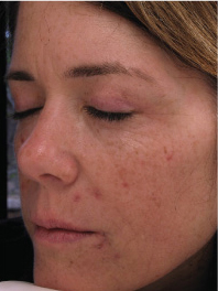 Before and after image of a woman’s face showcasing skin improvement from Triniti™ treatment, highlighting reduced acne scars and enhanced skin tone.