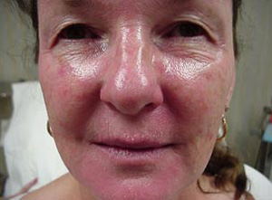 Close-up of a woman's face showing skin redness and slight swelling, representing the before stage of a Photofacial treatment at Envie Skin and Body.