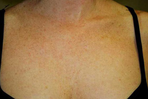 After Photofacial treatment showing improved skin texture and reduced freckles on chest area.