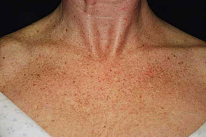 Before image of skin showing freckles and uneven tone, highlighting the area treated with Photofacial at Envie Skin and Body.