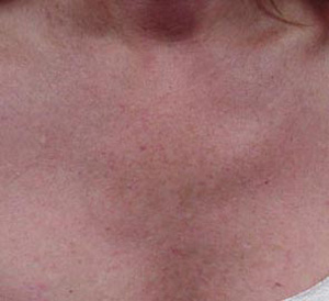 Before and after comparison of skin texture and appearance following a Photofacial treatment at Envie Skin and Body, showcasing improved clarity and reduced freckles.