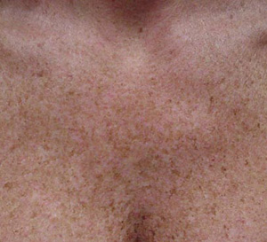 Freckled skin before Photofacial treatment at Envie Skin and Body, showcasing skin texture and pigmentation.