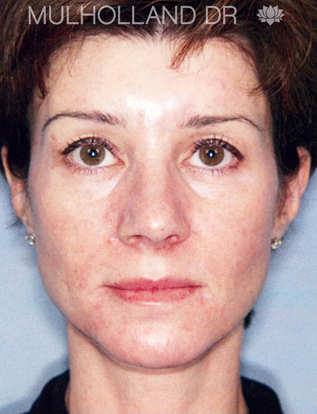 Woman's face with improved skin tone and texture after Triniti™ treatment, showcasing aesthetic enhancement for Envie Skin and Body.