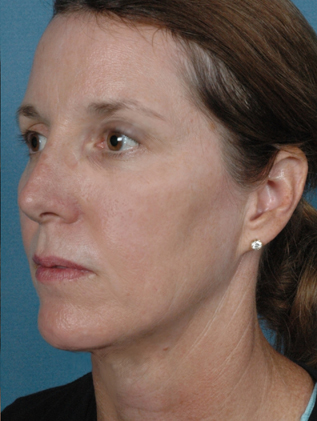 Profile view of a woman with smooth skin, minimal visible wrinkles, and a focused expression, illustrating results of Triniti™ treatment at Envie Skin and Body.