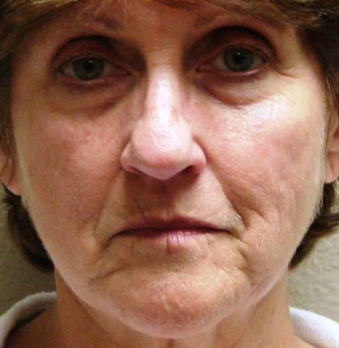 Before and after image comparison of a woman's facial skin, highlighting the effects of Triniti™ treatment at Envie Skin and Body, showcasing improved skin tone and reduced wrinkles.