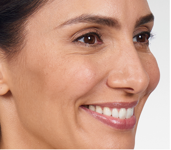 Smiling woman showcasing smooth skin after Botox treatment, highlighting reduced frown lines and improved facial appearance.