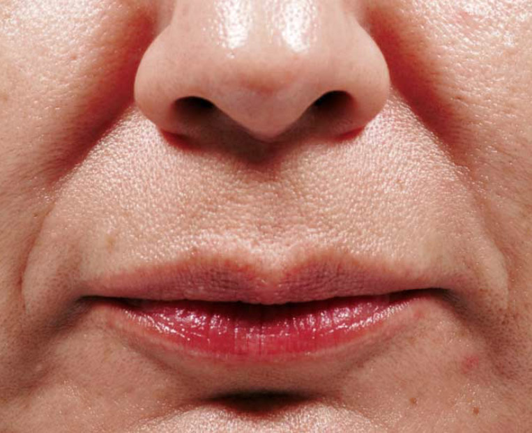 Close-up of a woman's lower face showcasing skin texture and subtle smile lines, illustrating before treatment with Bellafill for acne scars and smile lines.