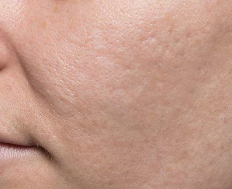 Close-up of a person's cheek showing smooth skin texture after Bellafill treatment for acne scars, illustrating effective results from the FDA-approved aesthetic procedure.