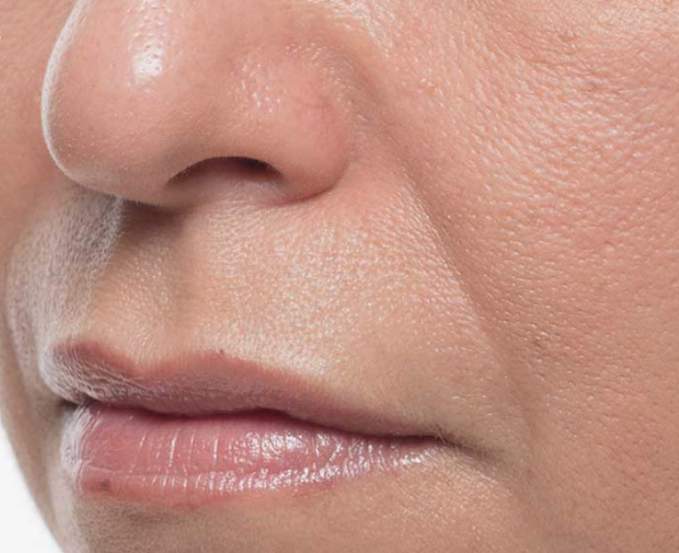 Close-up of a woman's face focusing on smooth skin texture around the nose and mouth, highlighting results of Bellafill treatment for acne scars and smile lines.