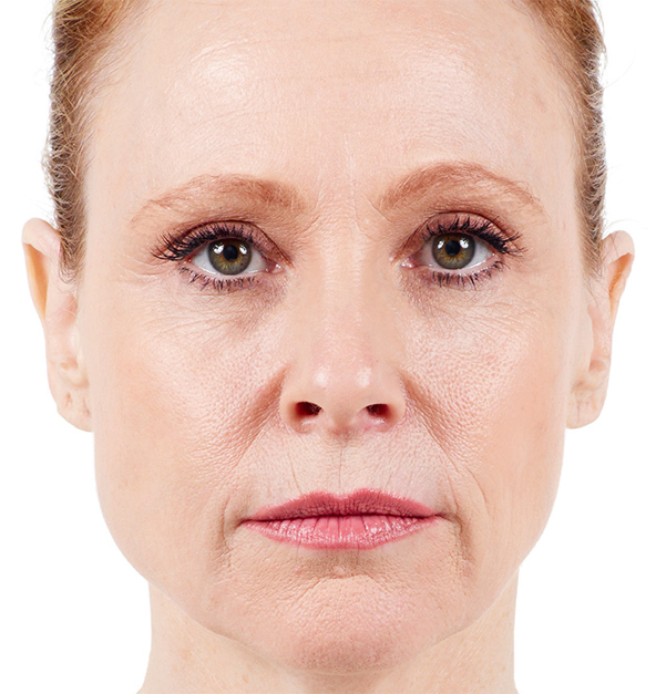 Woman's face with visible signs of aging, showcasing wrinkles and fine lines, emphasizing the need for Juvéderm treatment for smoother skin and enhanced facial features.