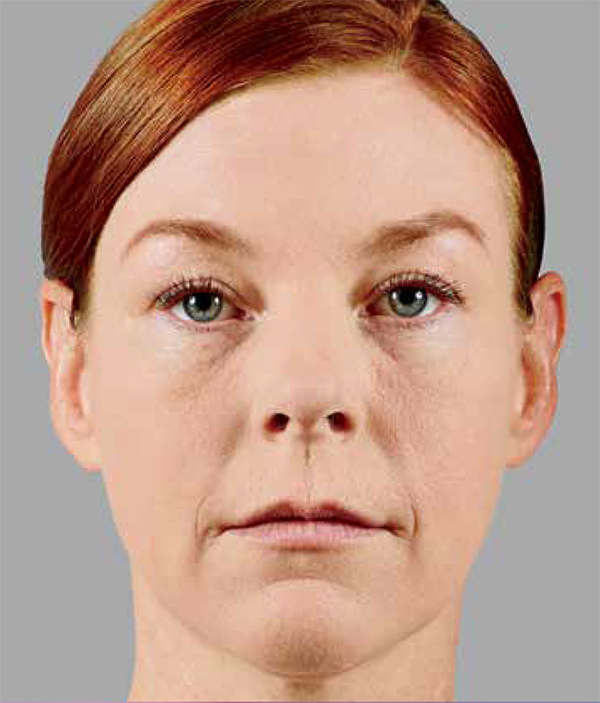 Woman's face before Juvéderm treatment, showing visible signs of aging, including fine lines and less volume in cheeks and lips.