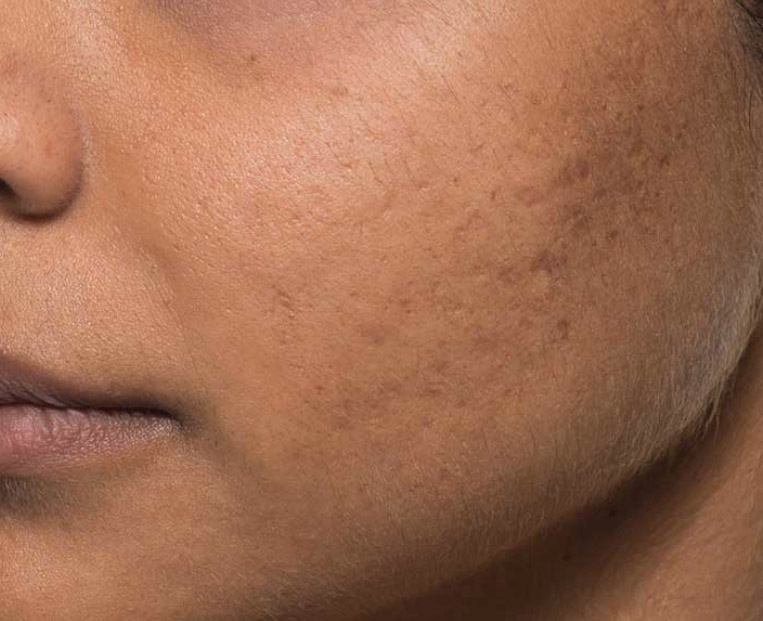 Close-up of a model's cheek showing acne scars and uneven skin texture, highlighting the potential results of Bellafill treatment for acne scars at Envie Skin and Body.