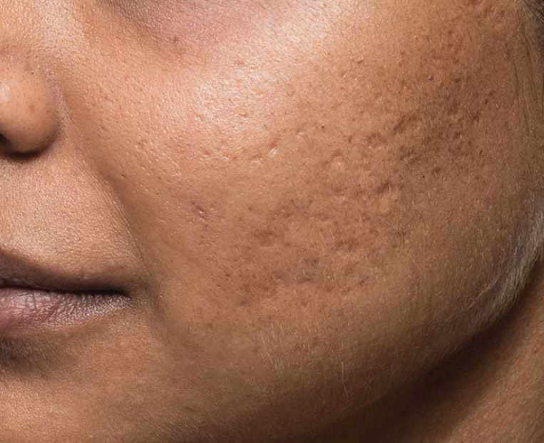 Close-up of a cheek showing acne scars, highlighting skin texture and imperfections, relevant to Bellafill treatment for acne scars at Envie Skin and Body.