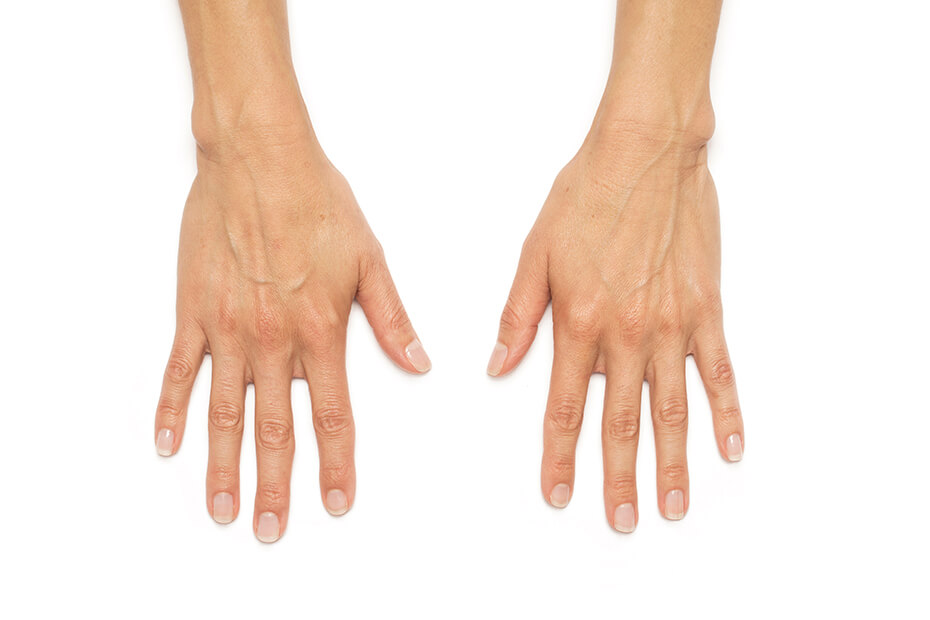 Before image of hands showing visible signs of aging, highlighting the need for Radiesse dermal filler treatment at Envie Skin and Body.