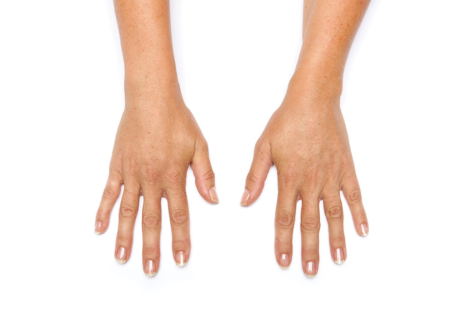 Hands showing improved appearance after Radiesse treatment, highlighting smoother skin texture and youthful look, relevant to Envie Skin and Body's aesthetic services.