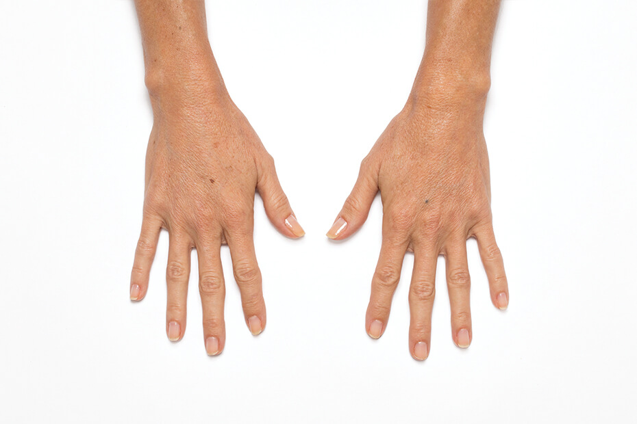 Hands showcasing improved appearance after Radiesse treatment, highlighting smoother skin texture and enhanced volume, relevant to Envie Skin and Body's aesthetic services.