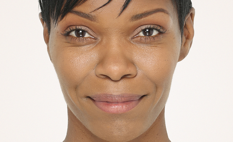 Close-up of a woman with smooth skin and a subtle smile, showcasing the results of Radiesse dermal filler treatment for facial enhancement.