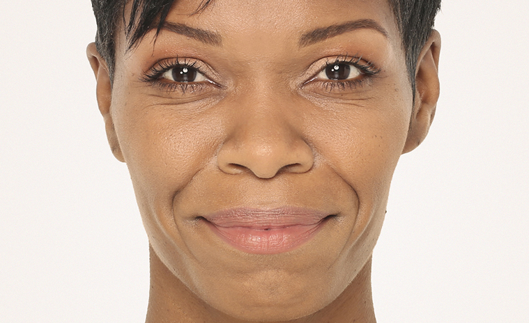 Woman with smooth, rejuvenated skin showcasing results of Radiesse dermal filler treatment, highlighting facial enhancement for aesthetic purposes.