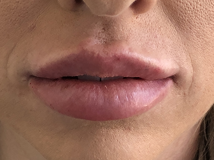 Photo Feb 09, 11 59 07 AM Close-up of enhanced lips showcasing results of cosmetic lip treatment, emphasizing fullness and smooth texture, relevant to Envie Skin and Body's lip enhancement procedures.