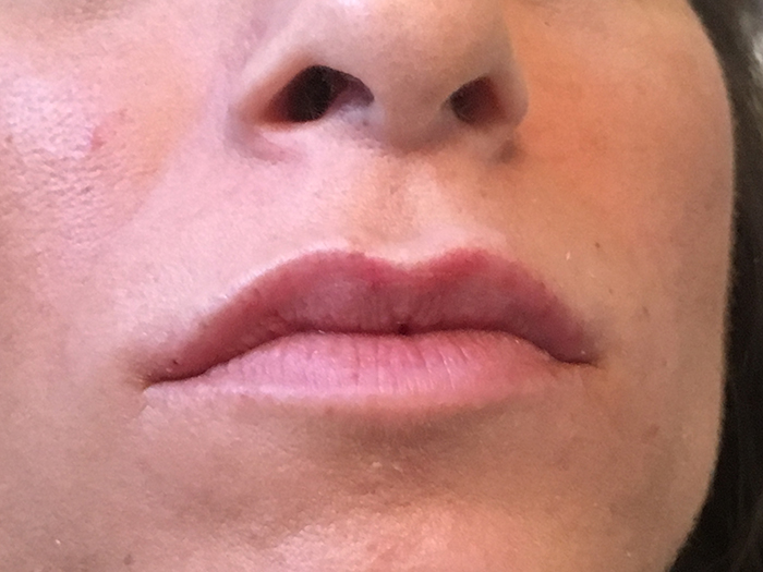Photo Feb 14, 5 08 25 PM Close-up of lips showcasing subtle enhancement results from cosmetic treatment, highlighting before-and-after effects related to lip augmentation at Envie Skin and Body.