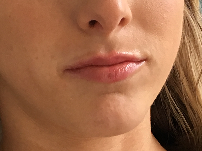 Photo Jan 02, 3 11 42 PM Close-up of lips after enhancement treatment, showcasing fuller appearance and smooth texture, relevant to Envie Skin and Body's lip enhancement services.