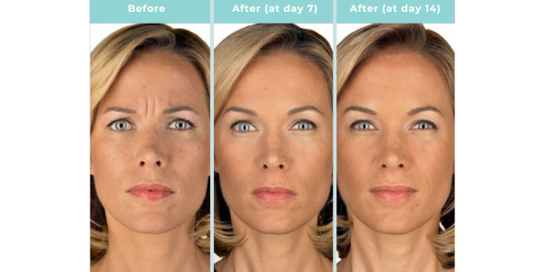 25 Before and after images of a woman's face showing results of BOTOX® Cosmetic treatment, highlighting reduction of frown lines and improved facial smoothness over 14 days.
