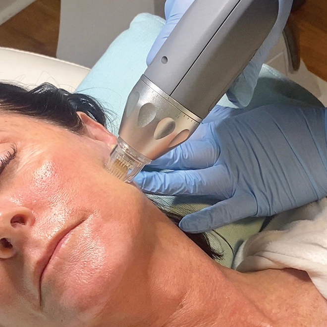 Woman receiving PiXel8-RF microneedling treatment with radiofrequency energy for skin rejuvenation, enhancing texture and tone, in a skincare clinic setting.