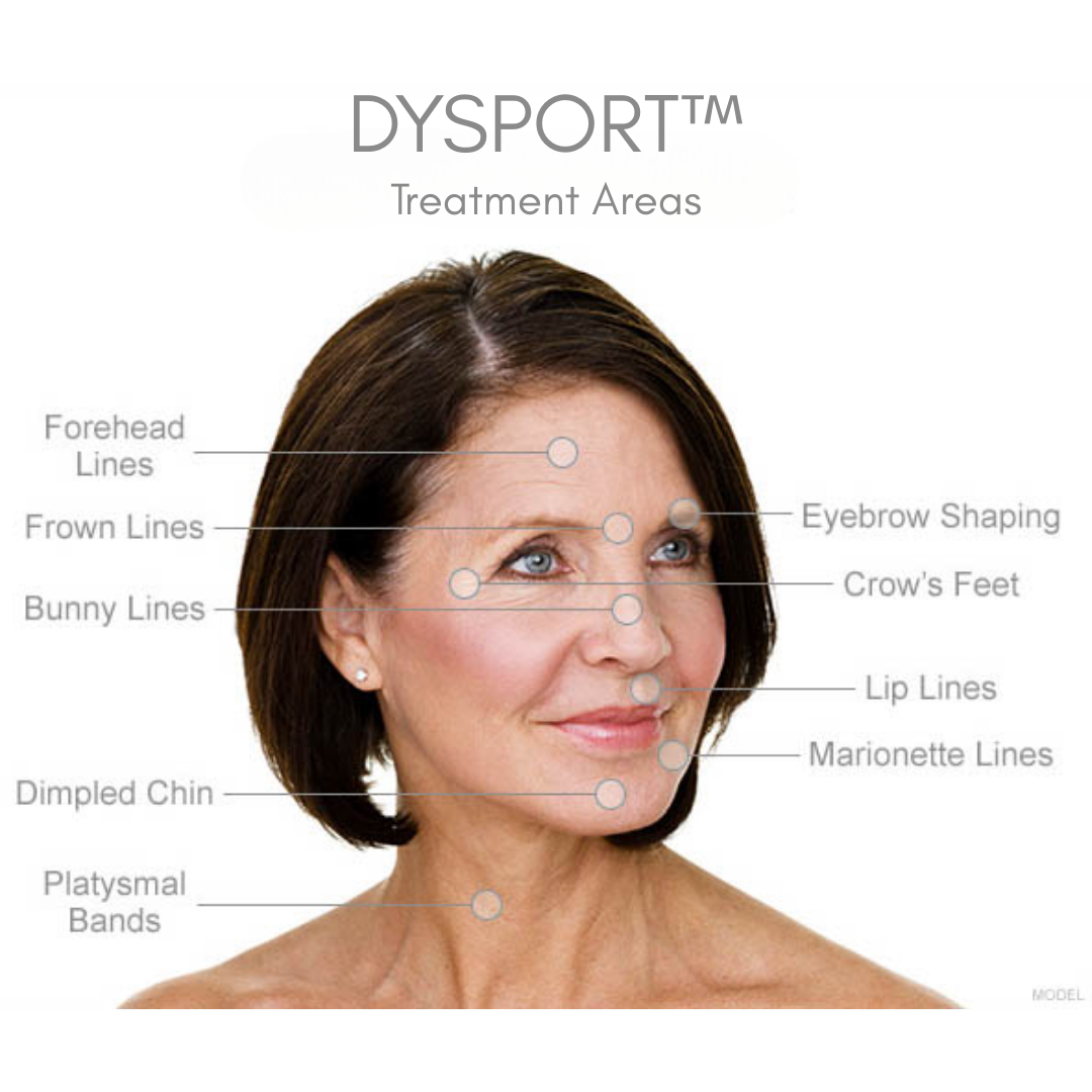 Dysport treatment areas diagram highlighting forehead lines, frown lines, bunny lines, eyebrow shaping, crow's feet, lip lines, marionette lines, dimpled chin, and platysmal bands on a woman's face.