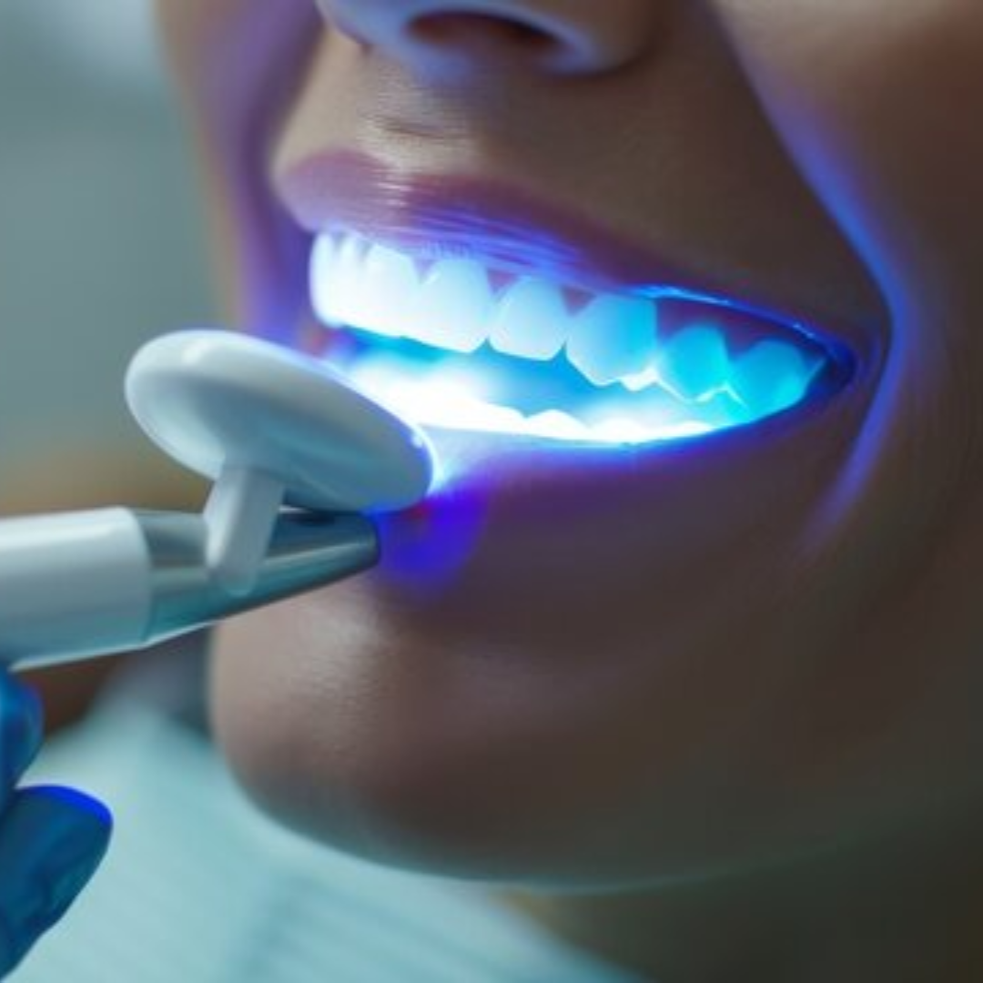 2 Teeth whitening treatment in progress, showcasing bright white teeth illuminated by blue LED light and a whitening device, emphasizing the TheraGlow system's effectiveness at Envie Skin & Body.