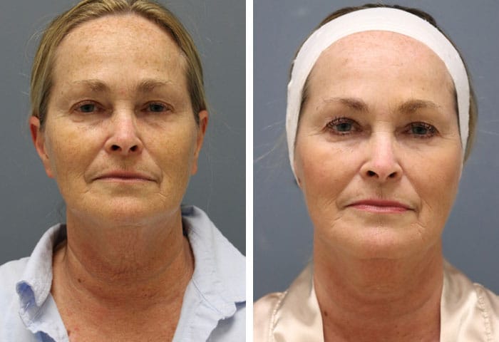 Before and after images showcasing the results of PiXel8-RF microneedling treatment, highlighting improved skin texture, firmness, and reduced signs of aging.