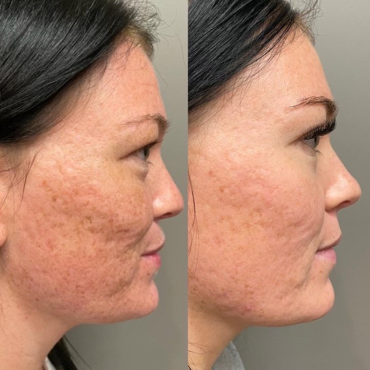 Before and after comparison of a client's skin showing significant improvement in texture and tone after PiXel8-RF treatment, highlighting reduced acne scars and firmer skin.